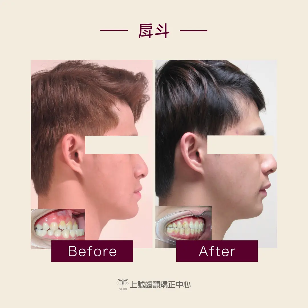 下巴前凸就是戽斗嗎?快看矯正專科醫師怎麼解釋 1 下巴突出矯正案例