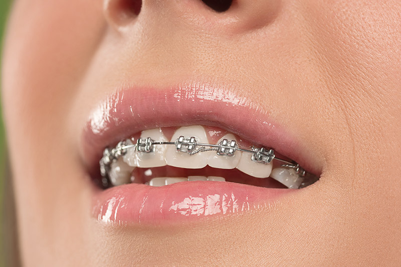 beautiful-young-woman-with-teeth-braces-7PF5YKS