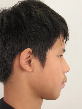 Read more about the article 隱適美孩童案例 / 郭小朋友
