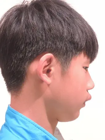 隱適美孩童案例 / 郭小朋友 1 case before郭小朋友1