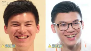 台中牙齒矯正推薦 13 莊子毅