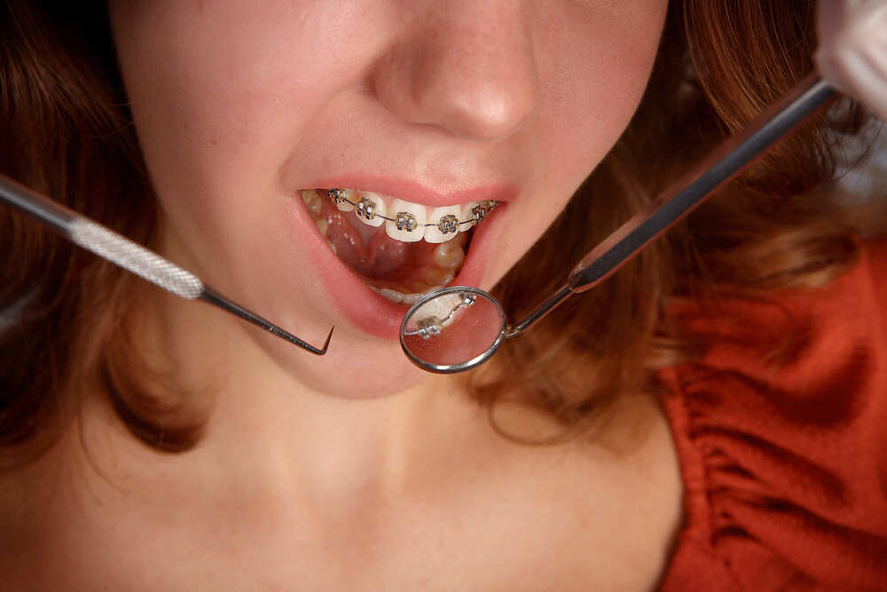 girl teeth braces and dentist tools 2022 11 11 08 21 42 utc 1