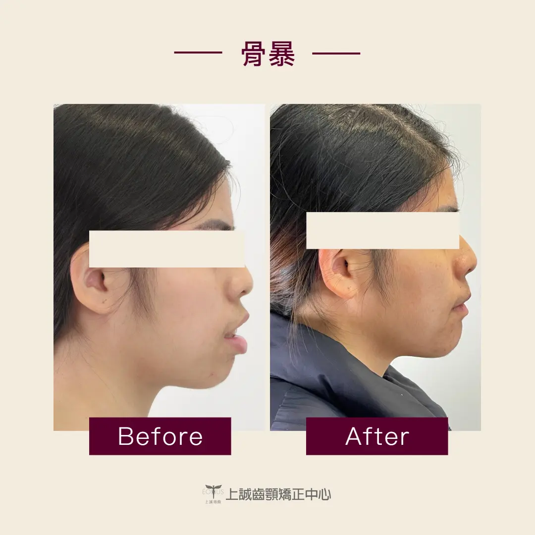 骨性暴牙矯正的原理是什麼? 2 骨性暴牙矯正案例-側面