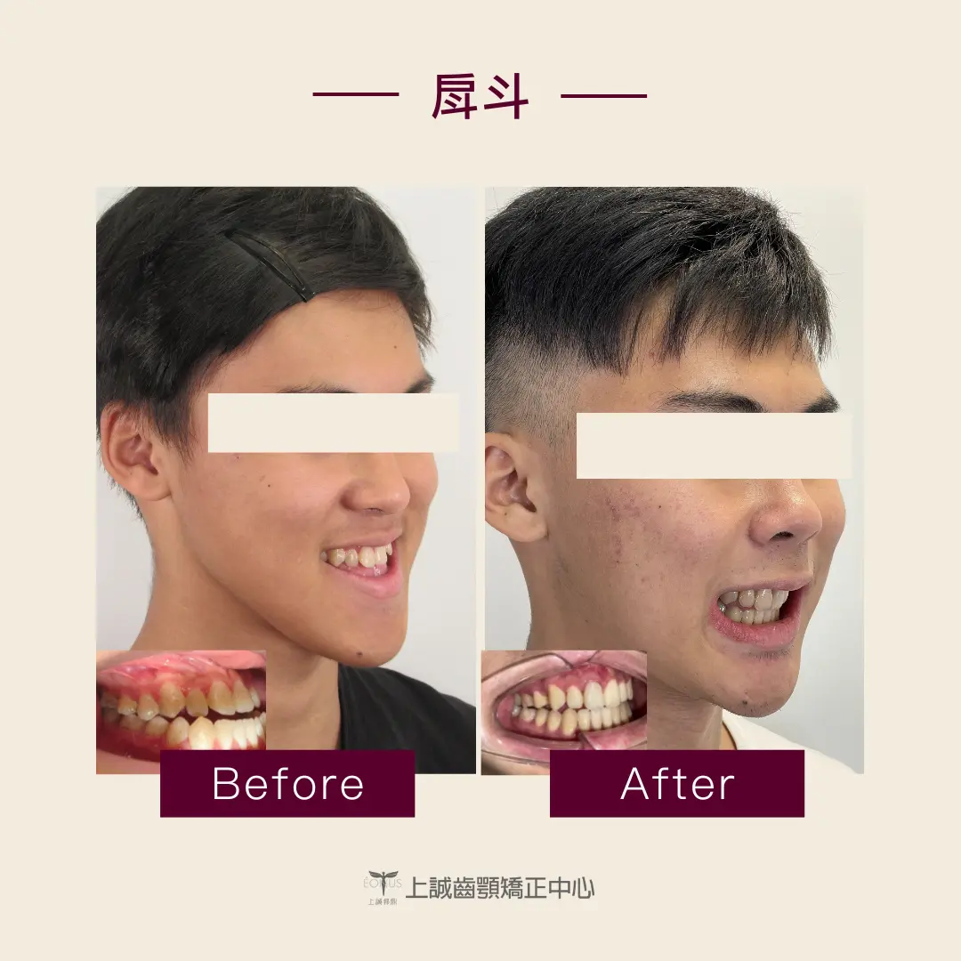 Read more about the article 戽斗原因是什麼？戽斗會越來越嚴重嗎？