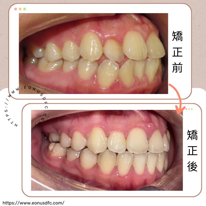 牙齒矯正4