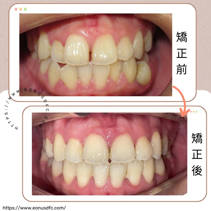 牙齒矯正3