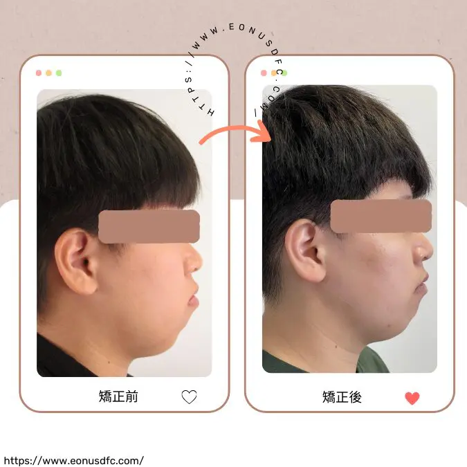 矯正你的牙齒,改善你的牙周健康 2 牙齒矯正2