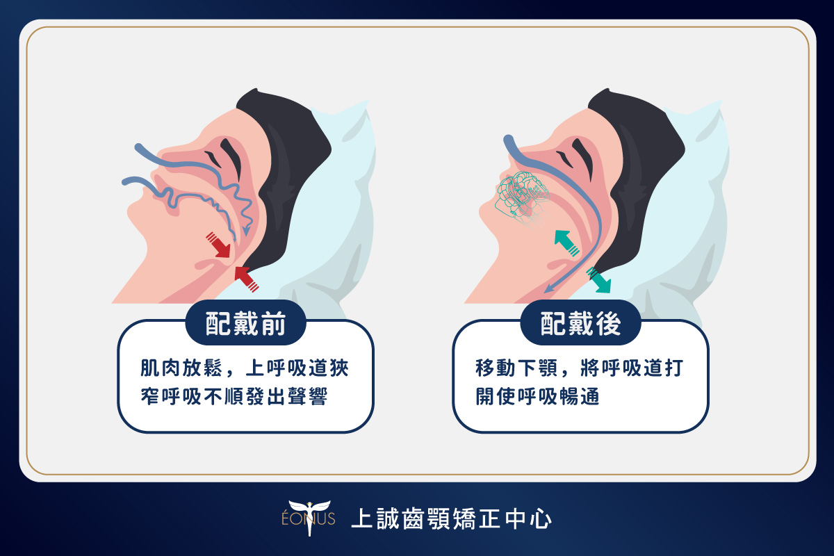 睡眠門診|止鼾器 4 before after wearing snoring appliance