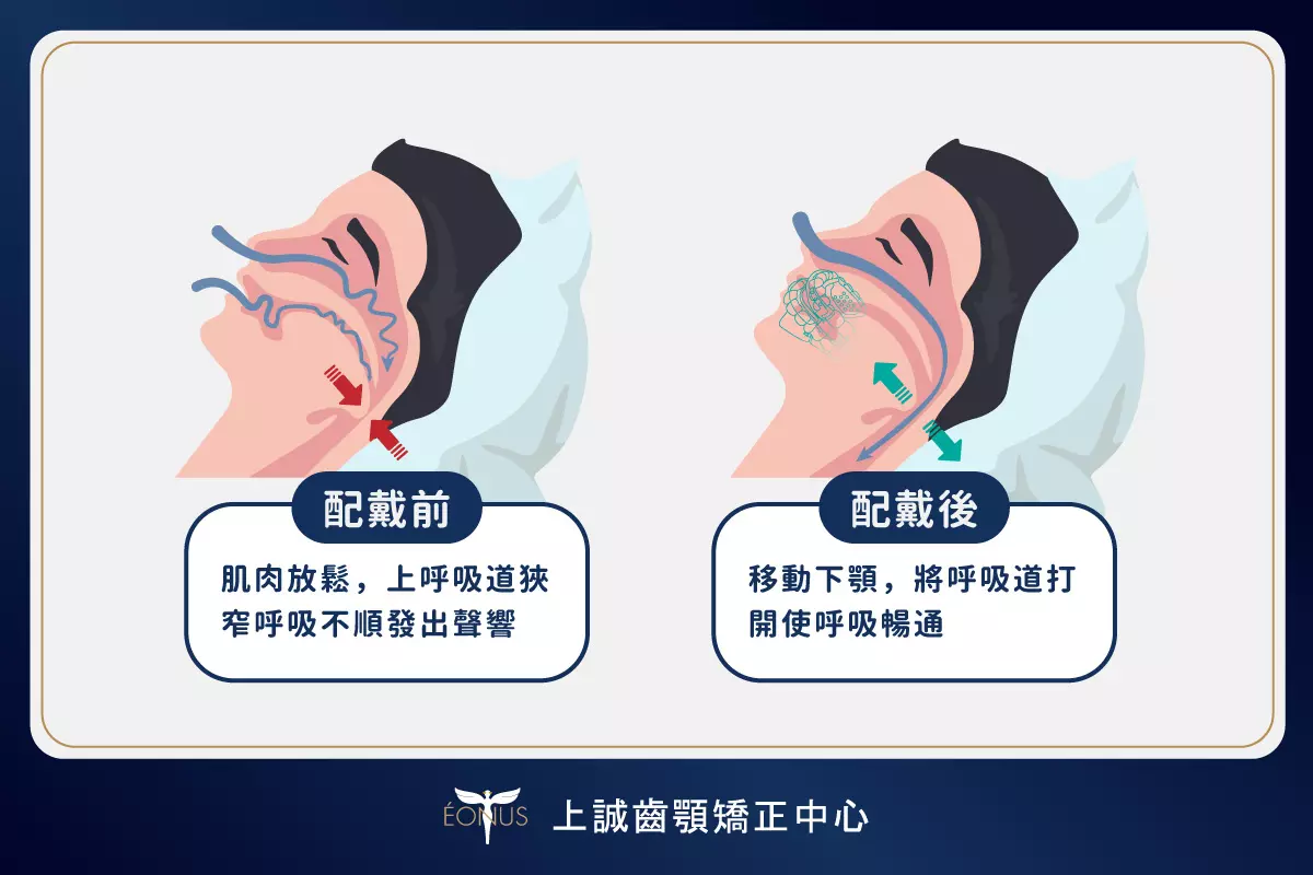 before after wearing snoring appliance
