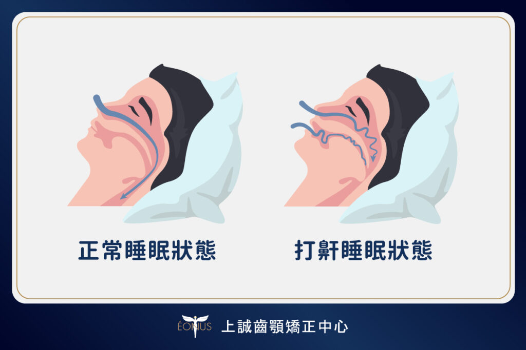 睡眠門診|止鼾器 1 causes of snoring