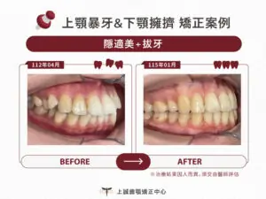 矯正失敗 3 上誠牙醫 齒顎矯正 26